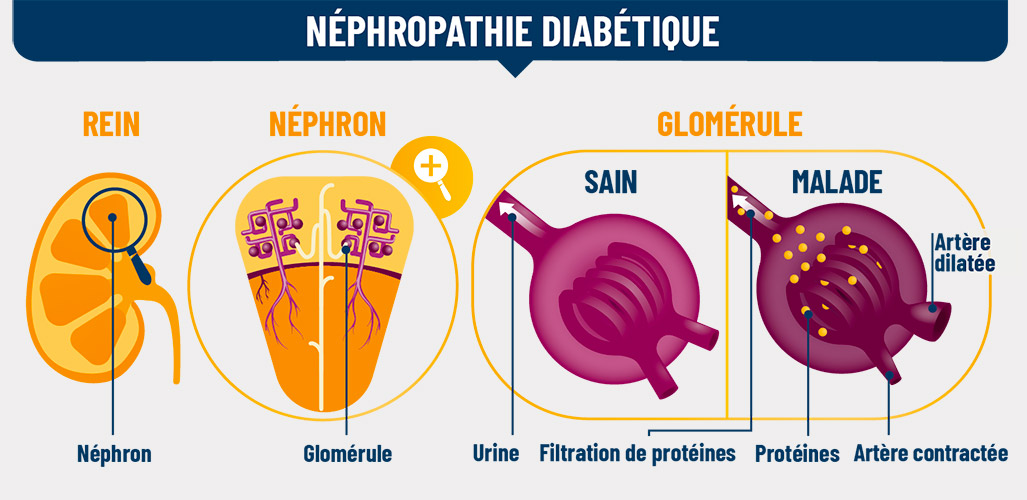 Schéma montrant l’impact de la néphropathie diabétique sur le rein, le néphron et le glomérule